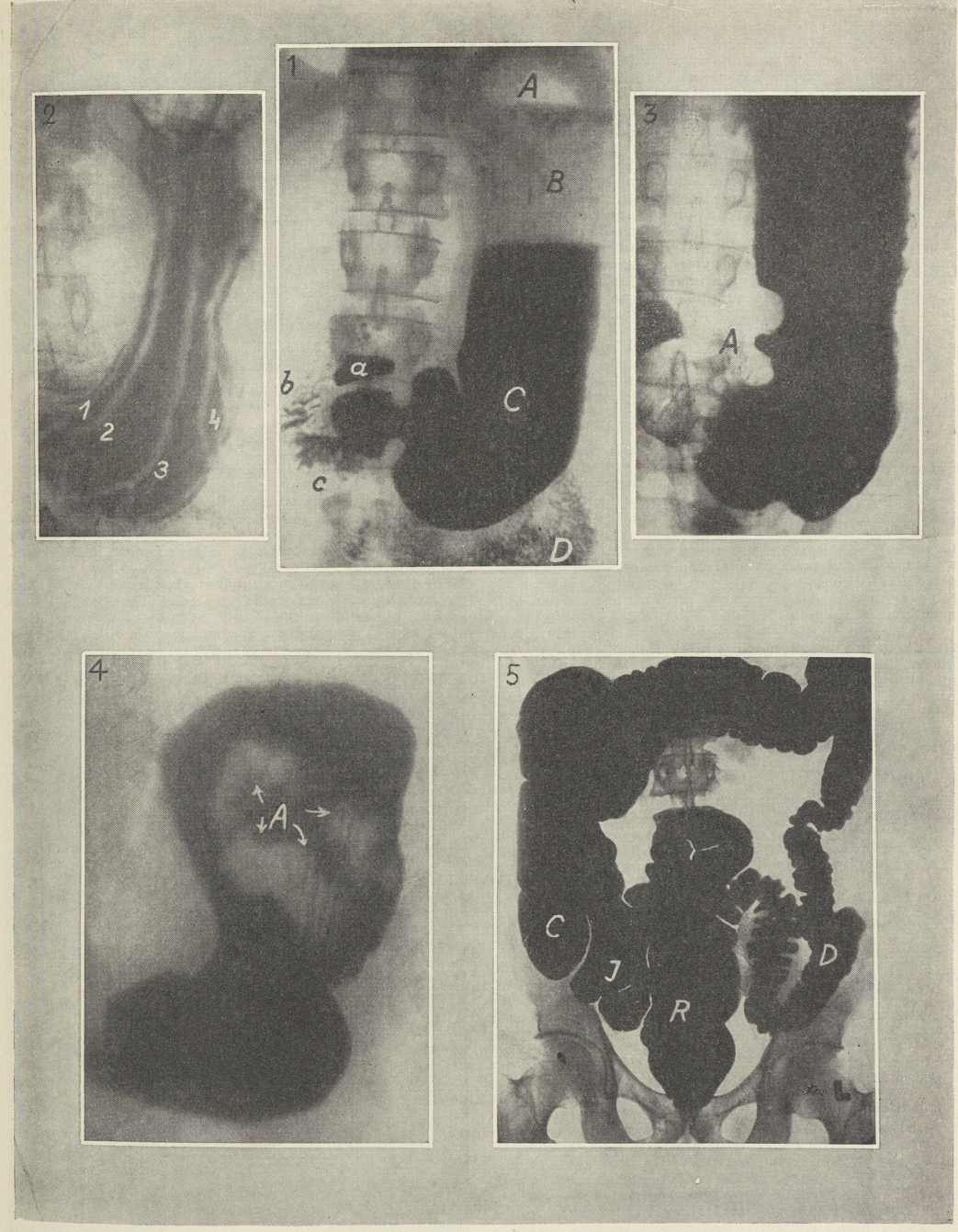 1. RENTGENOGRAM ŽELUCA (A, B, C,), DVANAESTNIKA (a, b, c) I POČETNIH VIJUGA TANKOGA CRIJEVA (D), punjenih barijevom kašom u uspravnom položaju.<br /> A mjehur zraka, B sloj sekreta iznad barijeva izljevka želuca (C).<br /> — 2. RENTGENOGRAM ŽELUČANE SLUZNICE. 1, 2, 3, 4 svijetle pruge, koje prikazuju bore sluznice u tamnoj slici nutarnje površine želuca, pokrivene tankim slojem barijeve kaše.<br /> — 3. ČIR ŽELUCA PREDOČEN BARIJEVOM KAŠOM. A izbočine barijeva izljevka želuca na mjestu, gdje je čir prodro u želučanu stijenu.<br /> — 4. RAK ŽELUCA PREDOČEN BARIJEVOM KAŠOM. A svijetle mrlje u rentgenogramu želuca prikazuju izljevak izrasline raka u barijevoj kaši.<br /> — 5. DEBELO CRIJEVO PREDOČENO BARIJEVOM KAŠOM PUTEM KLIZME.<br /> C (cekum) početni dio, R (rektum) završni dio, D (kolon descendens) silazni dio, koji je grčevito sužen, I (ileum) posljednje vijuge tankoga crijeva.